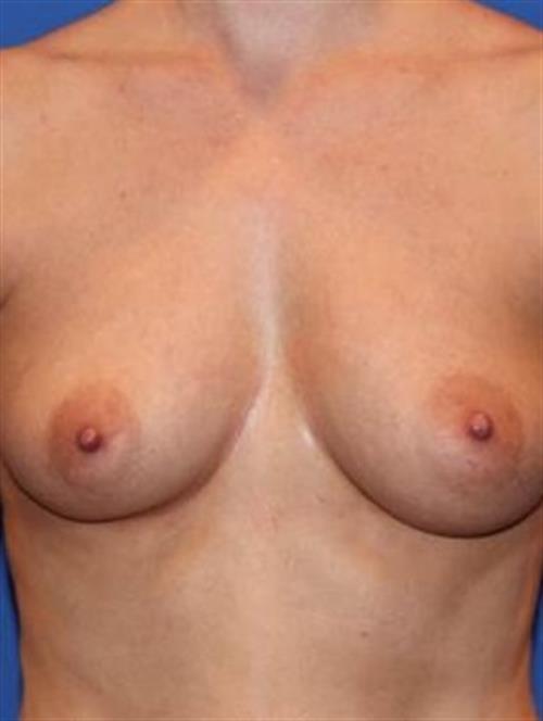 Breast Augmentation Before Photo | Phoenix and Scottsdale, AZ | Scottsdale Center for Plastic Surgery