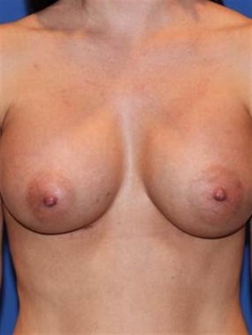 Breast Augmentation After Photo | Phoenix and Scottsdale, AZ | Scottsdale Center for Plastic Surgery