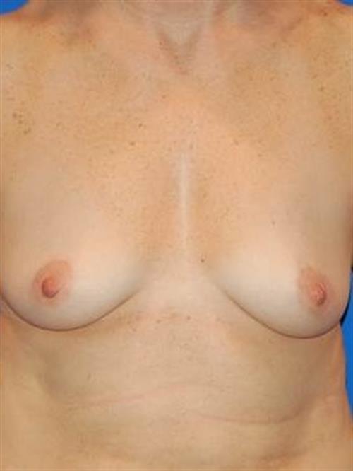 Sub-Fascial Breast Augmentation Before Photo | Phoenix and Scottsdale, AZ | Scottsdale Center for Plastic Surgery