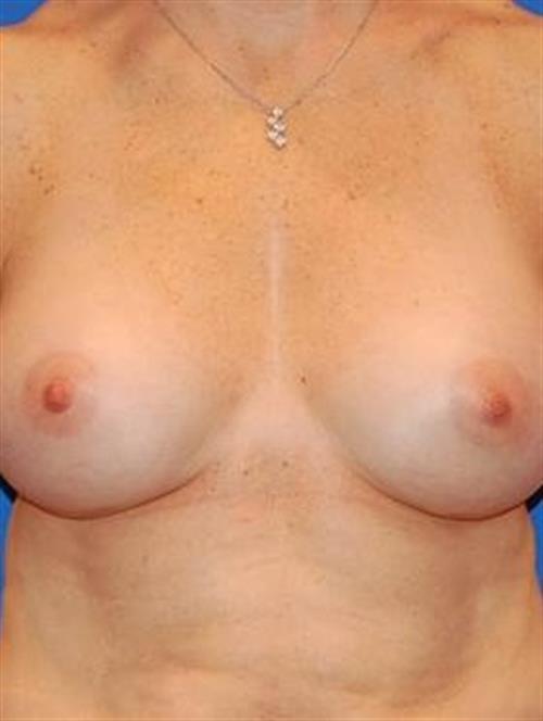 Sub-Fascial Breast Augmentation After Photo | Phoenix and Scottsdale, AZ | Scottsdale Center for Plastic Surgery