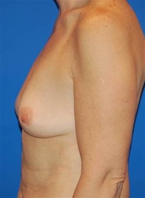 Sub-Fascial Breast Augmentation Before Photo | Phoenix and Scottsdale, AZ | Scottsdale Center for Plastic Surgery