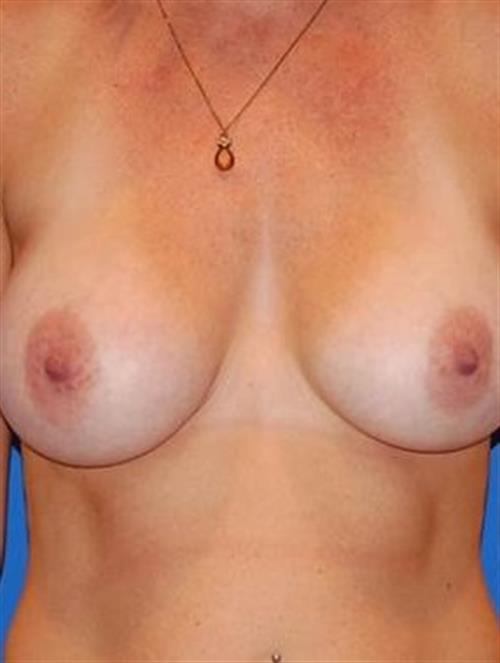 Sub-Fascial Breast Augmentation After Photo | Phoenix and Scottsdale, AZ | Scottsdale Center for Plastic Surgery