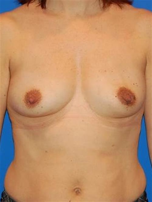 Breast Augmentation Before Photo | Phoenix and Scottsdale, AZ | Scottsdale Center for Plastic Surgery