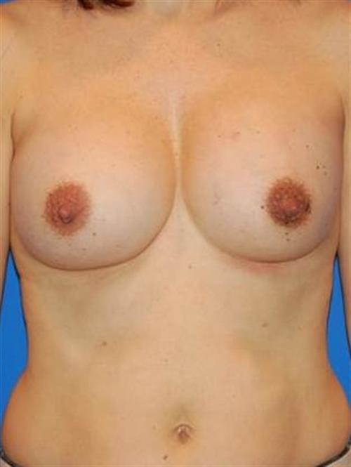 Breast Augmentation After Photo | Phoenix and Scottsdale, AZ | Scottsdale Center for Plastic Surgery