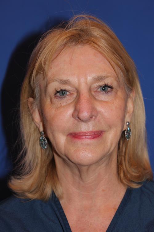 Facelift/Necklift Before Photo | Phoenix and Scottsdale, AZ | Scottsdale Center for Plastic Surgery