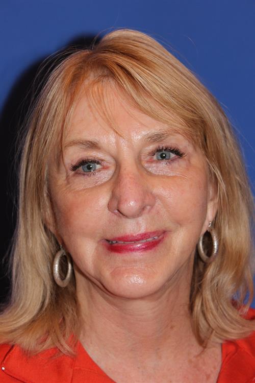 Facelift/Necklift After Photo | Phoenix and Scottsdale, AZ | Scottsdale Center for Plastic Surgery