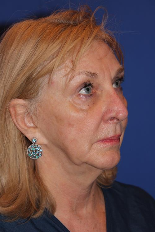 Facelift/Necklift Before Photo | Phoenix and Scottsdale, AZ | Scottsdale Center for Plastic Surgery
