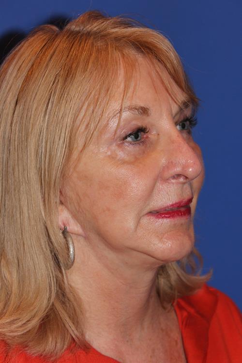 Facelift/Necklift After Photo | Phoenix and Scottsdale, AZ | Scottsdale Center for Plastic Surgery