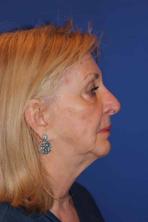 Facelift/Necklift Before Photo | Phoenix and Scottsdale, AZ | Scottsdale Center for Plastic Surgery