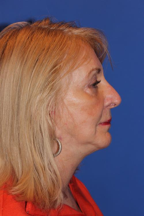 Facelift/Necklift After Photo | Phoenix and Scottsdale, AZ | Scottsdale Center for Plastic Surgery