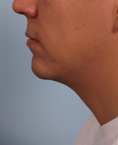 Chin Augmentation Before Photo | Phoenix and Scottsdale, AZ | Scottsdale Center for Plastic Surgery