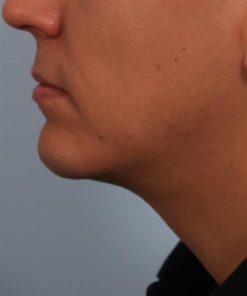 Chin Augmentation After Photo | Phoenix and Scottsdale, AZ | Scottsdale Center for Plastic Surgery