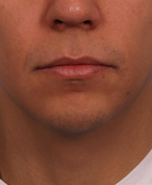 Chin Augmentation Before Photo | Phoenix and Scottsdale, AZ | Scottsdale Center for Plastic Surgery