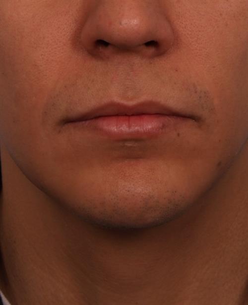 Chin Augmentation After Photo | Phoenix and Scottsdale, AZ | Scottsdale Center for Plastic Surgery