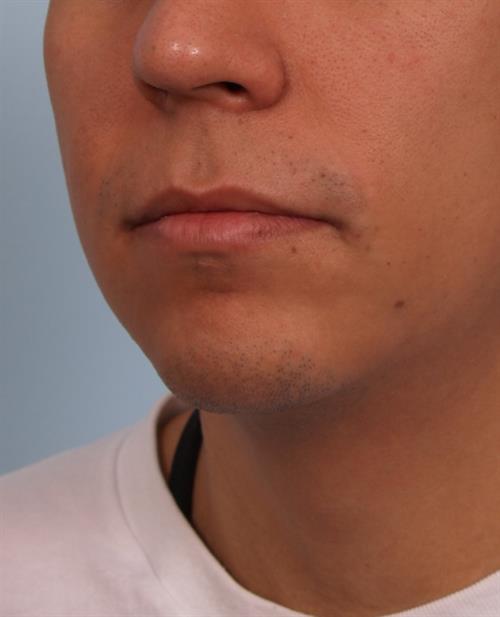 Chin Augmentation Before Photo | Phoenix and Scottsdale, AZ | Scottsdale Center for Plastic Surgery
