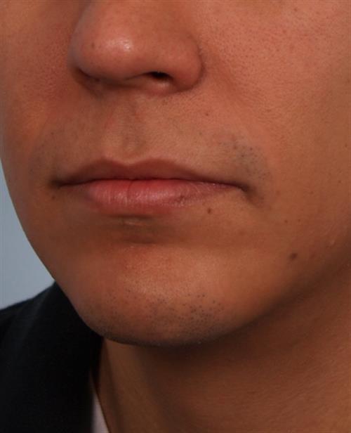 Chin Augmentation After Photo | Phoenix and Scottsdale, AZ | Scottsdale Center for Plastic Surgery