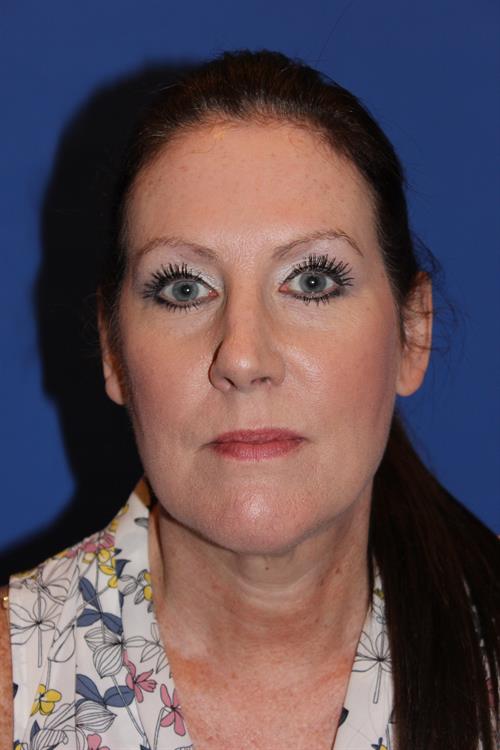 Facelift/Necklift Before Photo | Phoenix and Scottsdale, AZ | Scottsdale Center for Plastic Surgery