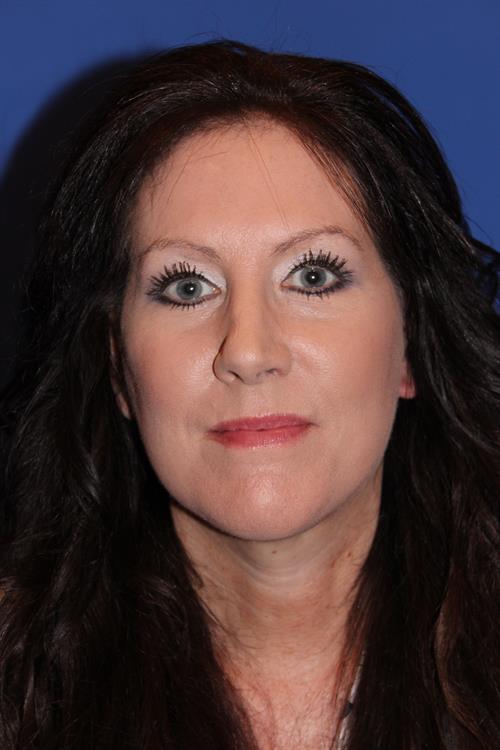 Facelift/Necklift After Photo | Phoenix and Scottsdale, AZ | Scottsdale Center for Plastic Surgery