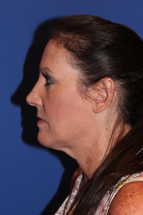 Facelift/Necklift Before Photo | Phoenix and Scottsdale, AZ | Scottsdale Center for Plastic Surgery