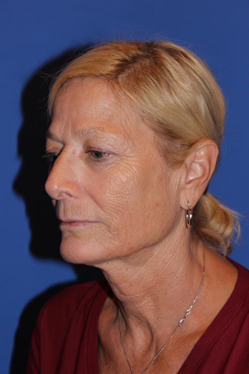 Facelift/Necklift Before Photo | Phoenix and Scottsdale, AZ | Scottsdale Center for Plastic Surgery
