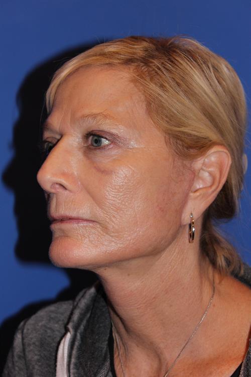Facelift/Necklift After Photo | Phoenix and Scottsdale, AZ | Scottsdale Center for Plastic Surgery