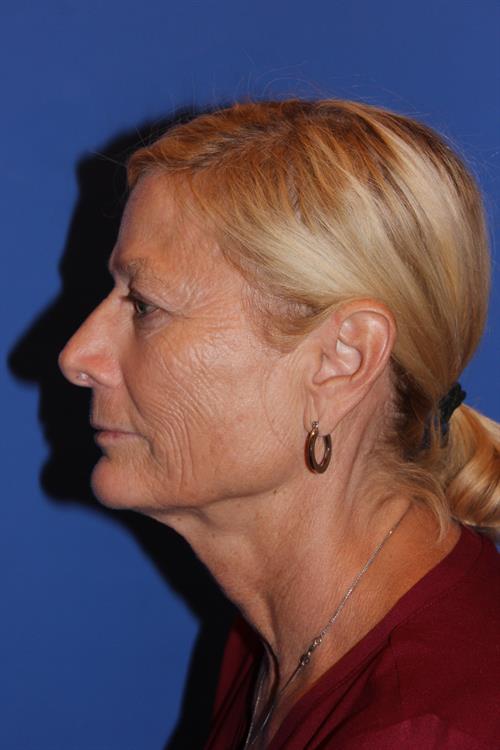 Facelift/Necklift Before Photo | Phoenix and Scottsdale, AZ | Scottsdale Center for Plastic Surgery