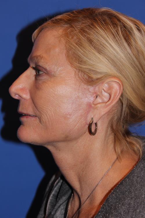 Facelift/Necklift After Photo | Phoenix and Scottsdale, AZ | Scottsdale Center for Plastic Surgery