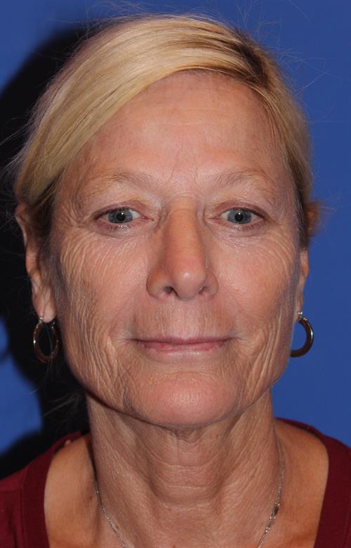 Facelift/Necklift Before Photo | Phoenix and Scottsdale, AZ | Scottsdale Center for Plastic Surgery