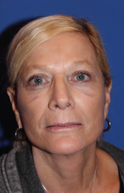 Facelift/Necklift After Photo | Phoenix and Scottsdale, AZ | Scottsdale Center for Plastic Surgery