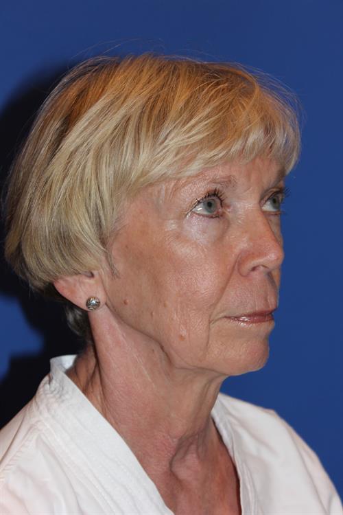 Facelift/Necklift Before Photo | Phoenix and Scottsdale, AZ | Scottsdale Center for Plastic Surgery