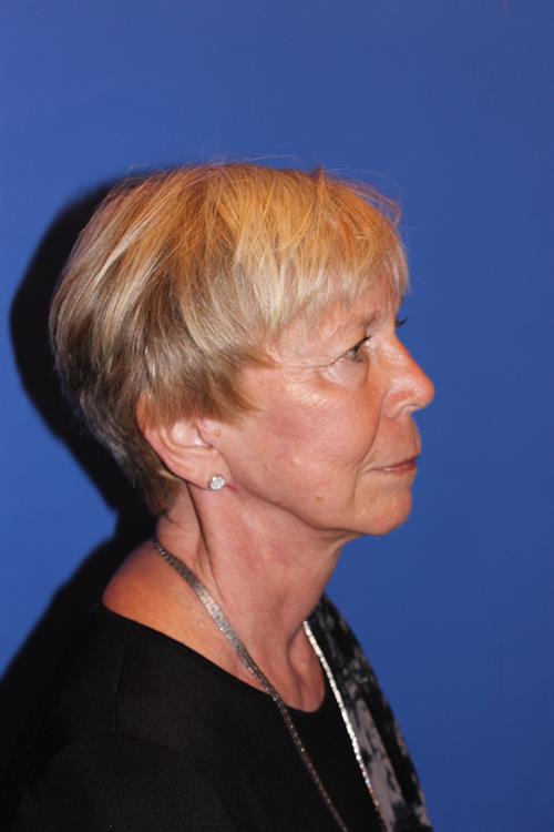Facelift/Necklift After Photo | Phoenix and Scottsdale, AZ | Scottsdale Center for Plastic Surgery