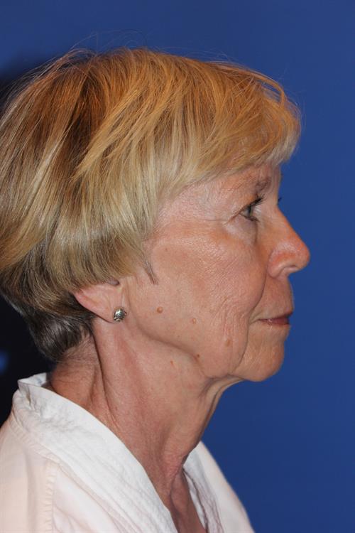Facelift/Necklift Before Photo | Phoenix and Scottsdale, AZ | Scottsdale Center for Plastic Surgery