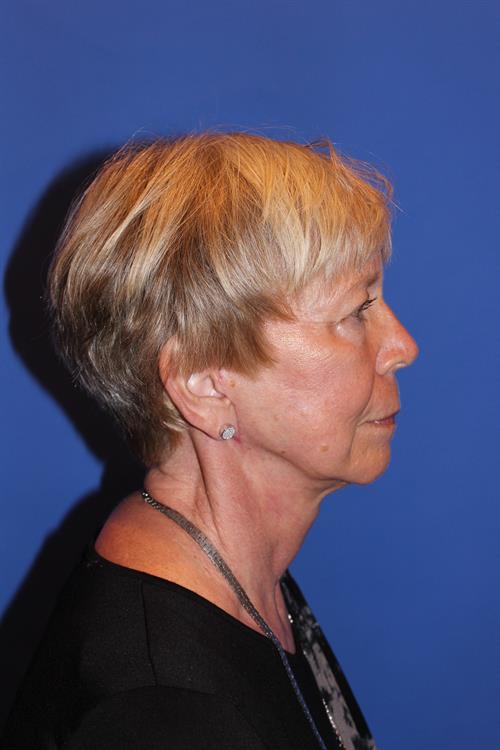Facelift/Necklift After Photo | Phoenix and Scottsdale, AZ | Scottsdale Center for Plastic Surgery
