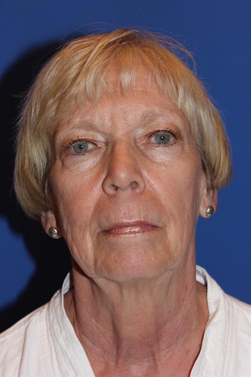 Facelift/Necklift Before Photo | Phoenix and Scottsdale, AZ | Scottsdale Center for Plastic Surgery