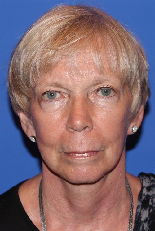 Facelift/Necklift After Photo | Phoenix and Scottsdale, AZ | Scottsdale Center for Plastic Surgery