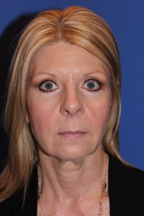 Facelift/Necklift Before Photo | Phoenix and Scottsdale, AZ | Scottsdale Center for Plastic Surgery