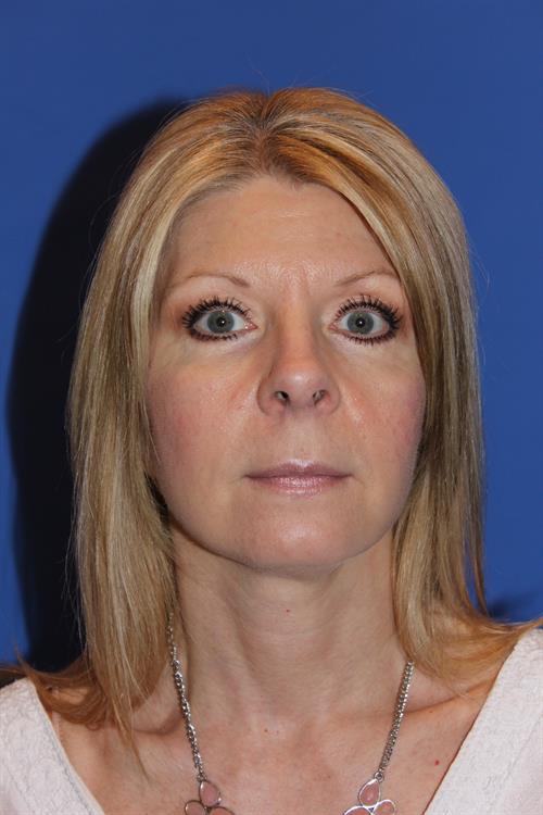 Facelift/Necklift After Photo | Phoenix and Scottsdale, AZ | Scottsdale Center for Plastic Surgery