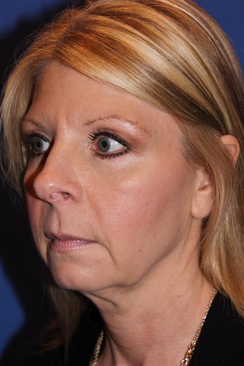 Facelift/Necklift Before Photo | Phoenix and Scottsdale, AZ | Scottsdale Center for Plastic Surgery