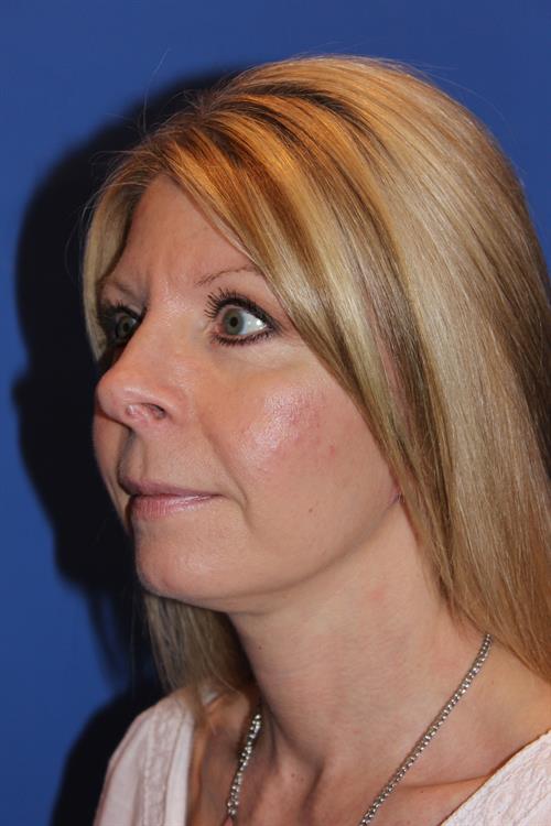 Facelift/Necklift After Photo | Phoenix and Scottsdale, AZ | Scottsdale Center for Plastic Surgery