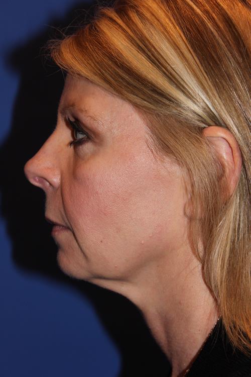 Facelift/Necklift Before Photo | Phoenix and Scottsdale, AZ | Scottsdale Center for Plastic Surgery