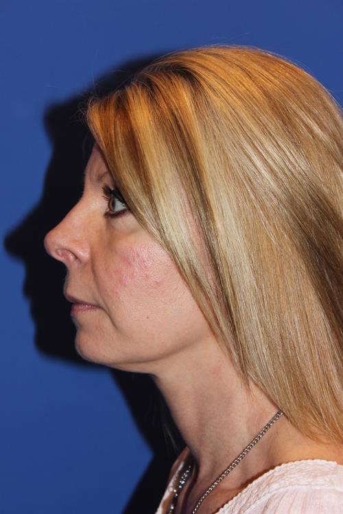 Facelift/Necklift After Photo | Phoenix and Scottsdale, AZ | Scottsdale Center for Plastic Surgery