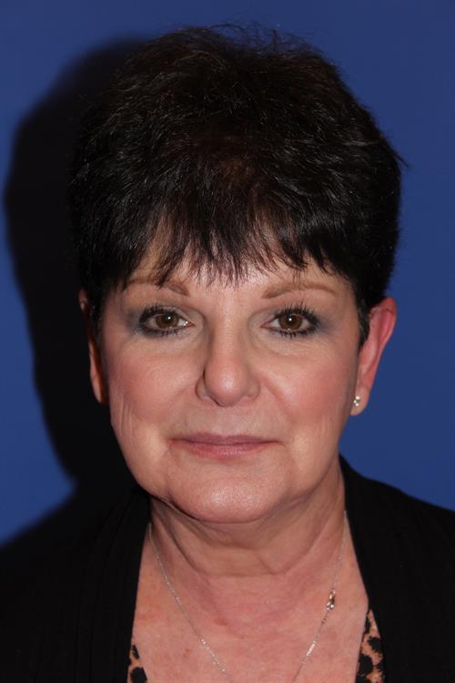 Facelift/Necklift Before Photo | Phoenix and Scottsdale, AZ | Scottsdale Center for Plastic Surgery