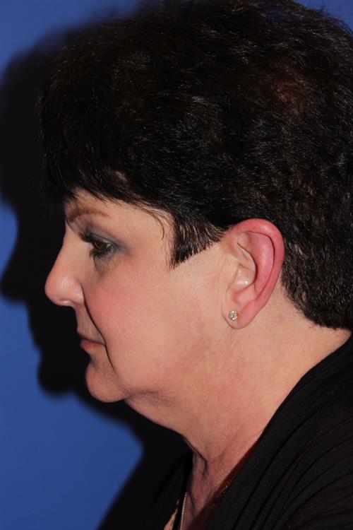 Facelift/Necklift Before Photo | Phoenix and Scottsdale, AZ | Scottsdale Center for Plastic Surgery