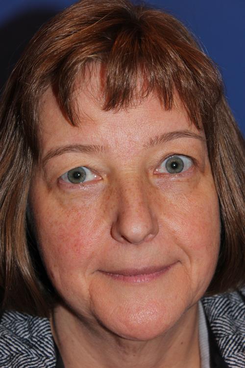 Facelift/Necklift Before Photo | Phoenix and Scottsdale, AZ | Scottsdale Center for Plastic Surgery