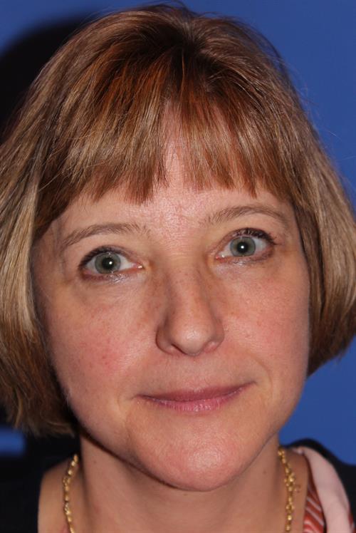 Facelift/Necklift After Photo | Phoenix and Scottsdale, AZ | Scottsdale Center for Plastic Surgery