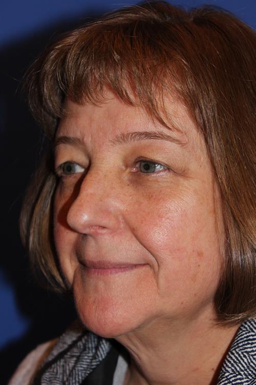 Facelift/Necklift Before Photo | Phoenix and Scottsdale, AZ | Scottsdale Center for Plastic Surgery