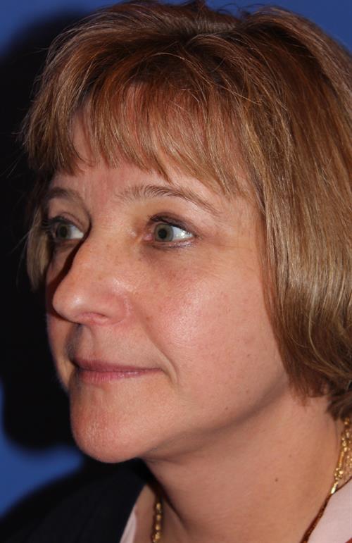 Facelift/Necklift After Photo | Phoenix and Scottsdale, AZ | Scottsdale Center for Plastic Surgery