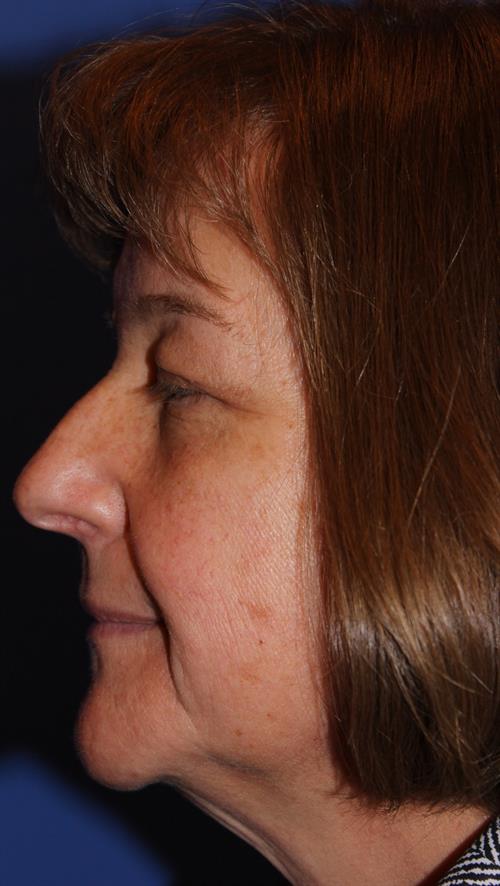 Facelift/Necklift Before Photo | Phoenix and Scottsdale, AZ | Scottsdale Center for Plastic Surgery