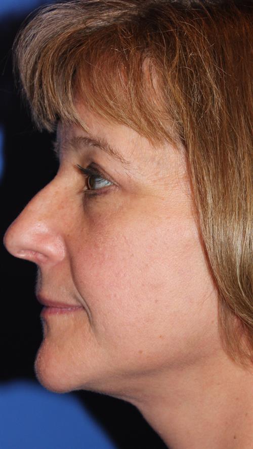 Facelift/Necklift After Photo | Phoenix and Scottsdale, AZ | Scottsdale Center for Plastic Surgery