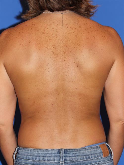 Breast Augmentation Before Photo | Phoenix and Scottsdale, AZ | Scottsdale Center for Plastic Surgery